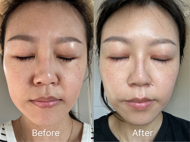 CurrentBody Series 2 LED Mask before and after